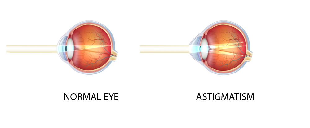 astigmatism graphic